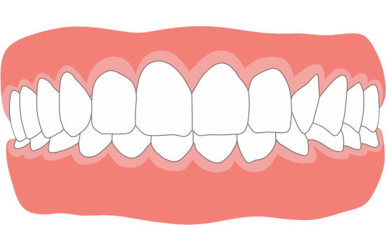 Глубокий прикус